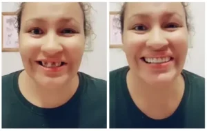 Instant-Smile-Veneers-Customer