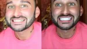 Snap-on-Smile-Veneers-Customer