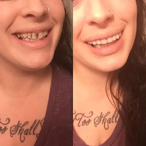 snap-on-smile-veneers-customer-review
